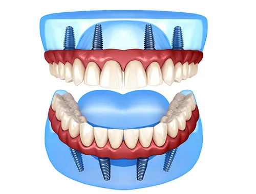 All-on-4 Dental Implants Diagram