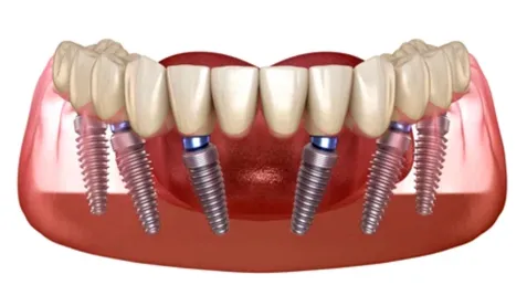 All-on-6 Dental Implants Diagram