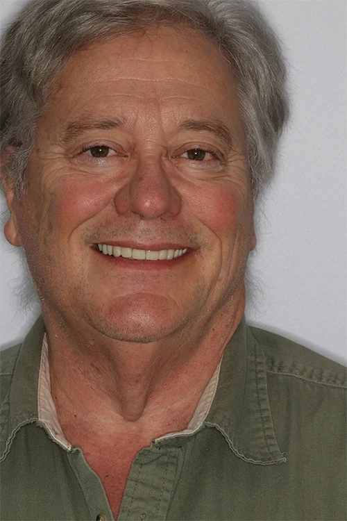 Close-up of a person's teeth before dental treatment, showing some discoloration and unevenness.