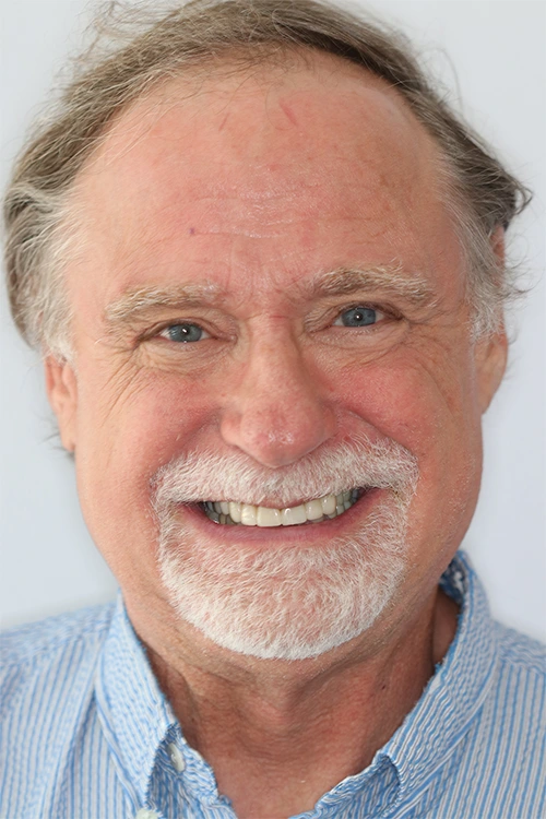 Close-up of a person's teeth before dental treatment, showing some discoloration and unevenness.