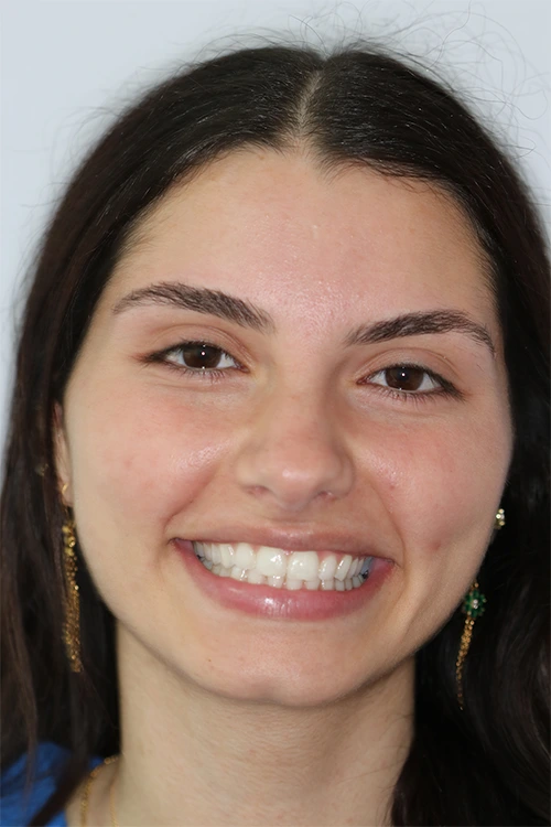Close-up of a person's teeth after dental treatment, showing a bright, white, and even smile.