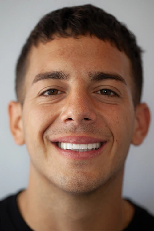Close-up of a person's teeth before dental treatment, showing some discoloration and unevenness.