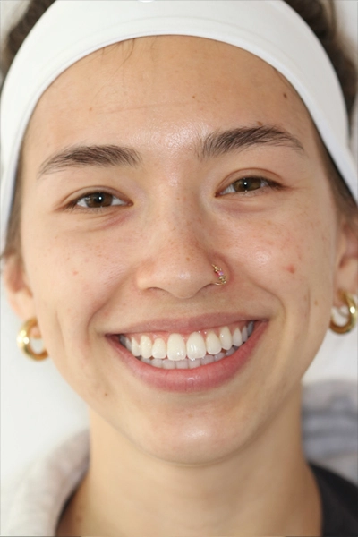 Close-up of a person's teeth before dental treatment, showing some discoloration and unevenness.