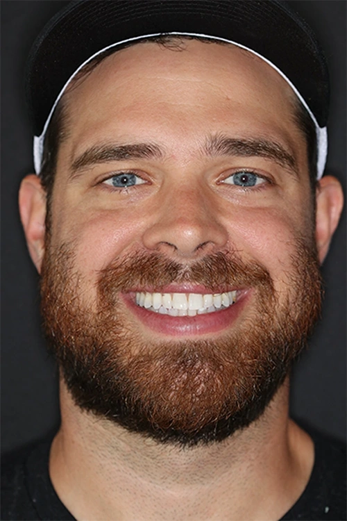 Close-up of a person's teeth after dental treatment, showing a bright, white, and even smile.