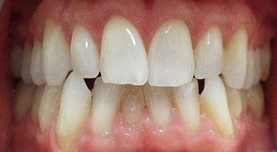 Close-up of a person's teeth before dental treatment, showing some discoloration and unevenness.