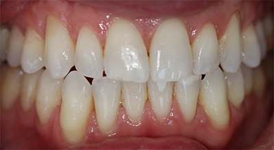 Close-up of a person's teeth before dental treatment, showing some discoloration and unevenness.