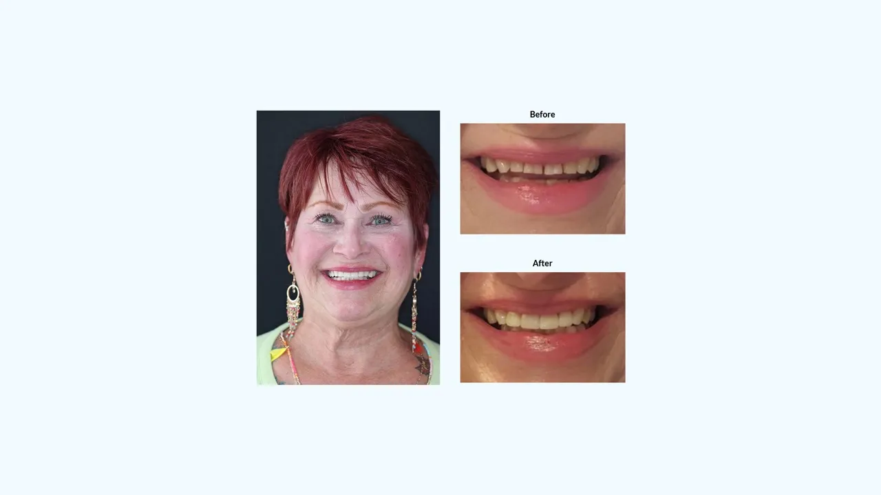 Smile gallery case 3