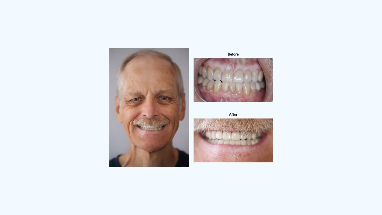 Smile gallery case 4