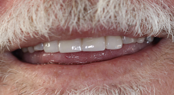 Close-up of teeth after dental treatment.