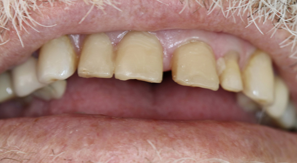 Close-up of teeth before dental treatment.