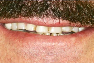 Close-up of a person's teeth before dental treatment, showing some discoloration and unevenness.