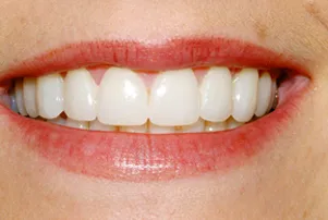 Close-up of a person's teeth after dental treatment, showing a bright, white, and even smile.