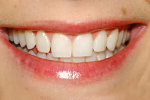 Close-up of a person's teeth before dental treatment, showing some discoloration and unevenness.