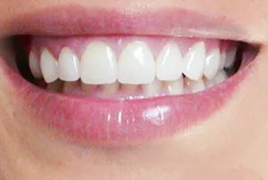 Close-up of a person's teeth after dental treatment, showing a bright, white, and even smile.