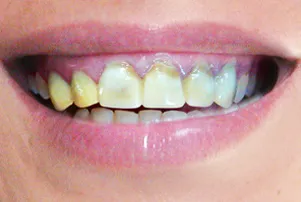 Close-up of a person's teeth before dental treatment, showing some discoloration and unevenness.