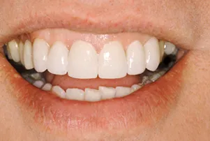 Close-up of a person's teeth after dental treatment, showing a bright, white, and even smile.