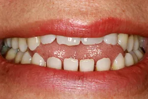 Close-up of a person's teeth before dental treatment, showing some discoloration and unevenness.