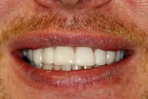 Close-up of a person's teeth after dental treatment, showing a bright, white, and even smile.