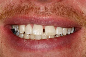 Close-up of a person's teeth before dental treatment, showing some discoloration and unevenness.