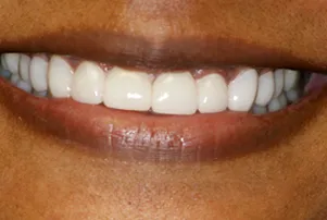 Close-up of a person's teeth after dental treatment, showing a bright, white, and even smile.