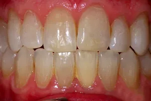 Close-up of a person's teeth after dental treatment, showing a bright, white, and even smile.
