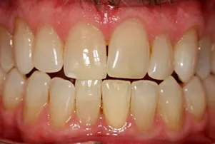 Close-up of a person's teeth before dental treatment, showing some discoloration and unevenness.