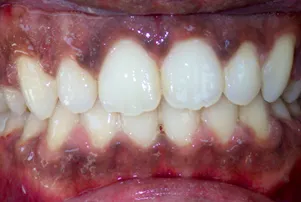 Close-up of a person's teeth after dental treatment, showing a bright, white, and even smile.
