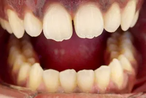 Close-up of a person's teeth before dental treatment, showing some discoloration and unevenness.