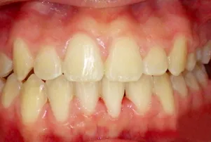 Close-up of a person's teeth after dental treatment, showing a bright, white, and even smile.