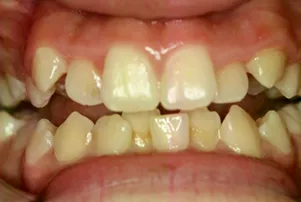 Close-up of a person's teeth before dental treatment, showing some discoloration and unevenness.