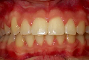 Close-up of a person's teeth after dental treatment, showing a bright, white, and even smile.