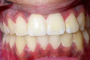 Close-up of a person's teeth after dental treatment, showing a bright, white, and even smile.