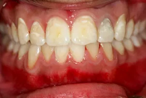 Close-up of a person's teeth before dental treatment, showing some discoloration and unevenness.