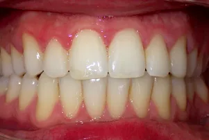 Close-up of a person's teeth after dental treatment, showing a bright, white, and even smile.