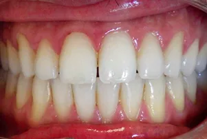 Close-up of a person's teeth before dental treatment, showing some discoloration and unevenness.