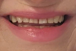 Close-up of a person's teeth before dental treatment, showing some discoloration and unevenness.