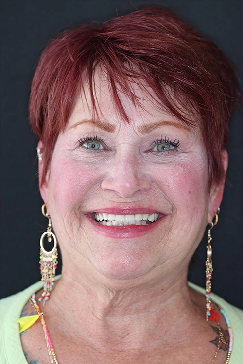 Close-up of a person's teeth after dental treatment, showing a bright, white, and even smile.