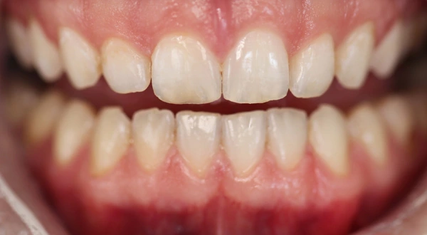 Close-up of a person's teeth before dental treatment, showing some discoloration and unevenness.