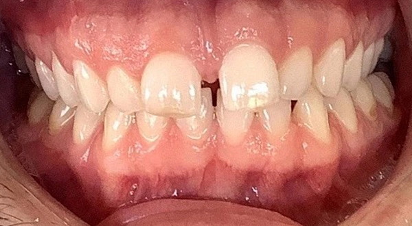Close-up of a person's teeth before dental treatment, showing some discoloration and unevenness.