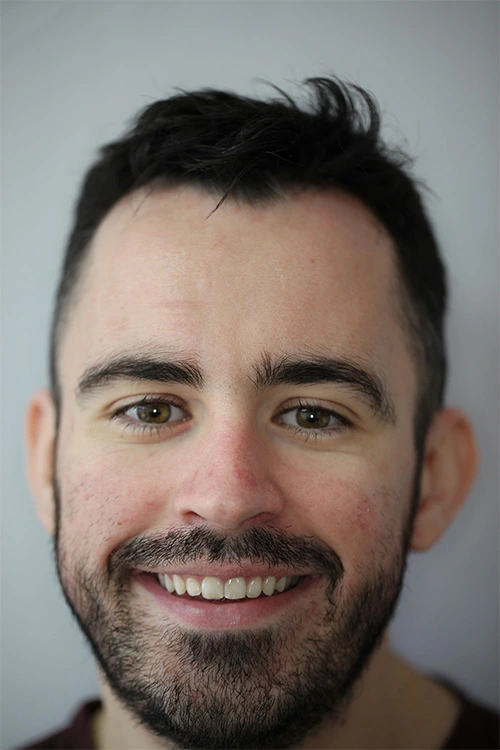 Close-up of a person's teeth after dental treatment, showing a bright, white, and even smile.