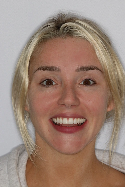 Close-up of a person's teeth after dental treatment, showing a bright, white, and even smile.