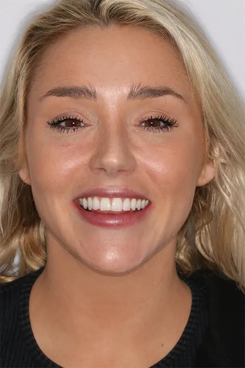 Invisalign smile result at Balboa Dentistry in San Diego