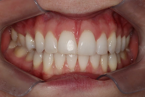 Close-up of a person's teeth before dental treatment, showing some discoloration and unevenness.