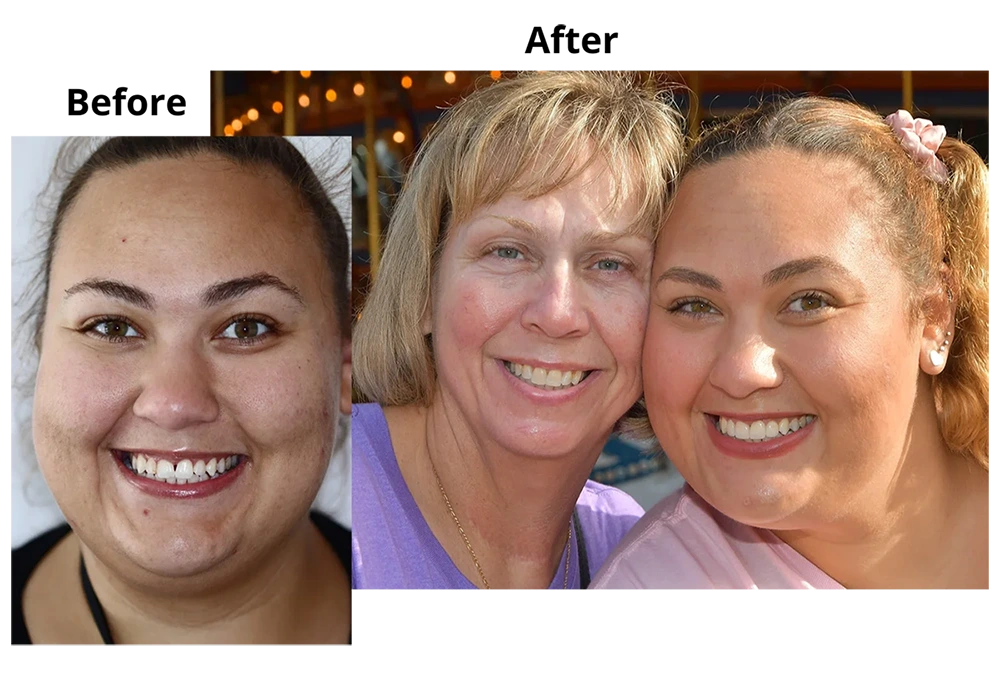 Close-up of a person's teeth after dental treatment, showing a bright, white, and even smile.