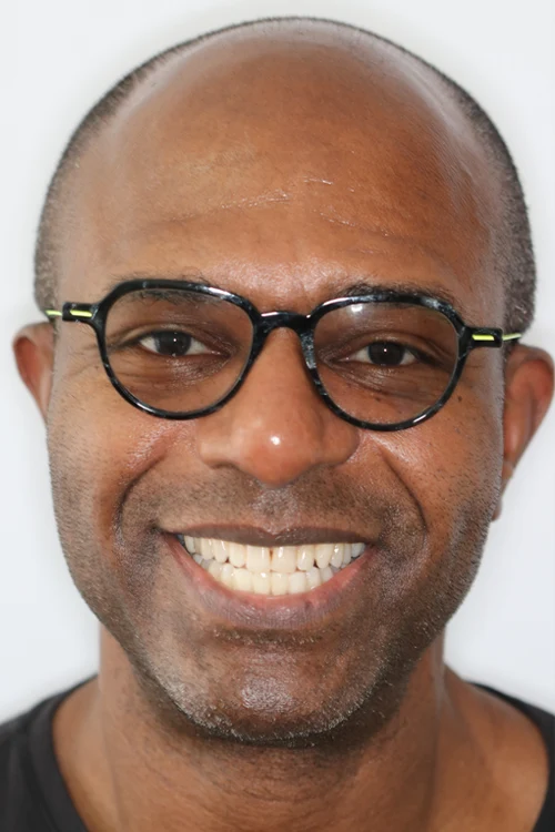 Close-up of a person's teeth before dental treatment, showing some discoloration and unevenness.