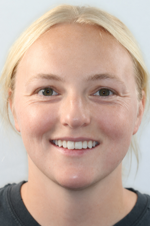 Balboa Dentistry patient smiling after dental treatment.