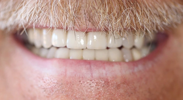 Close-up of a person's teeth before dental treatment, showing some discoloration and unevenness.