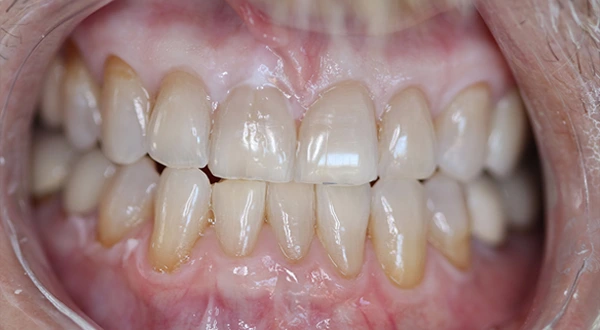 Close-up of a person's teeth before dental treatment, showing some discoloration and unevenness.