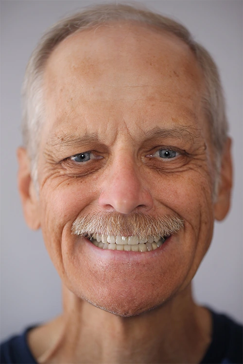 Close-up of a person's teeth after dental treatment, showing a bright, white, and even smile.
