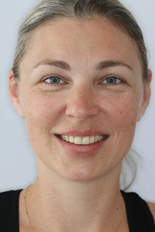 Close-up of a person's teeth after dental treatment, showing a bright, white, and even smile.